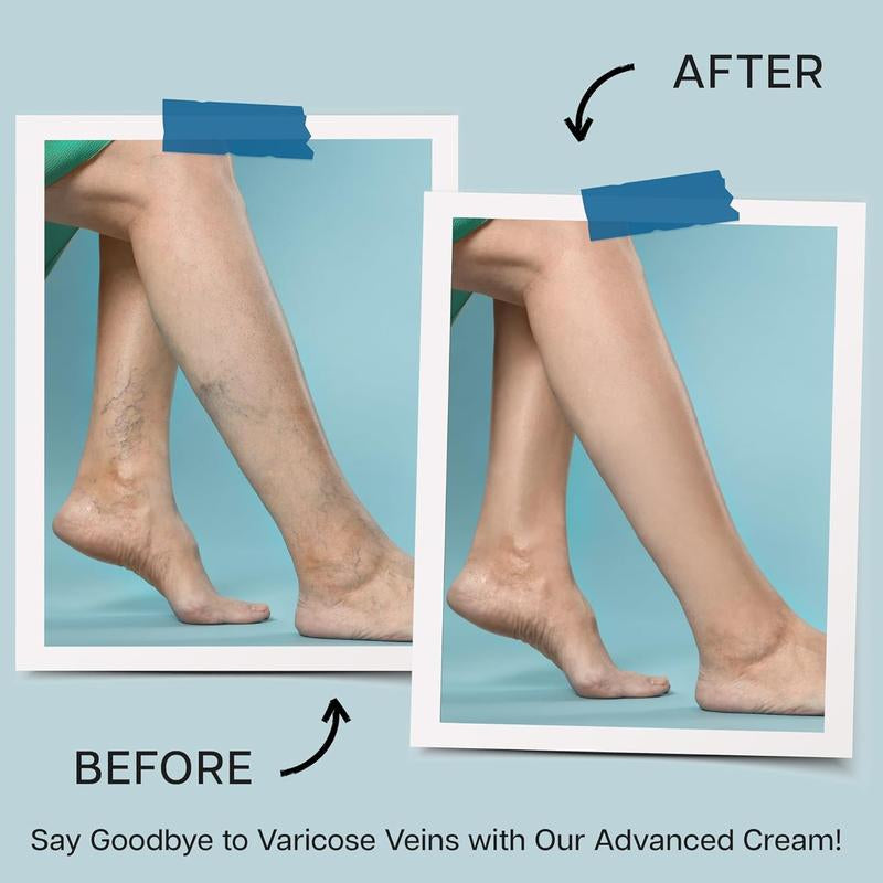 Varicose Veins Cream, Varicose Veins for Legs Made in Italy, Spider Vein for Legs, Natural Soothing Leg Varicose & Spider Veins Cream - 5.07 Fl Oz